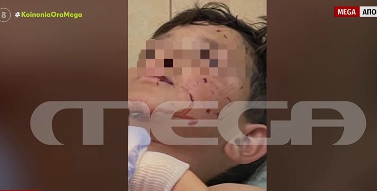 Λαγονήσι: Τι λέει η μητέρα του 14χρονου που δέχθηκε επίθεση από σκύλο