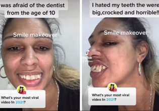 Είχε «δόντια αλόγου» και… για 20 χρόνια φοβόταν να πάει στον οδοντίατρο – Η θεαματική αλλαγή