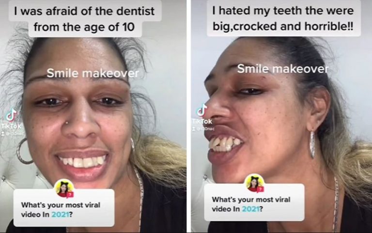 Είχε «δόντια αλόγου» και… για 20 χρόνια φοβόταν να πάει στον οδοντίατρο – Η θεαματική αλλαγή
