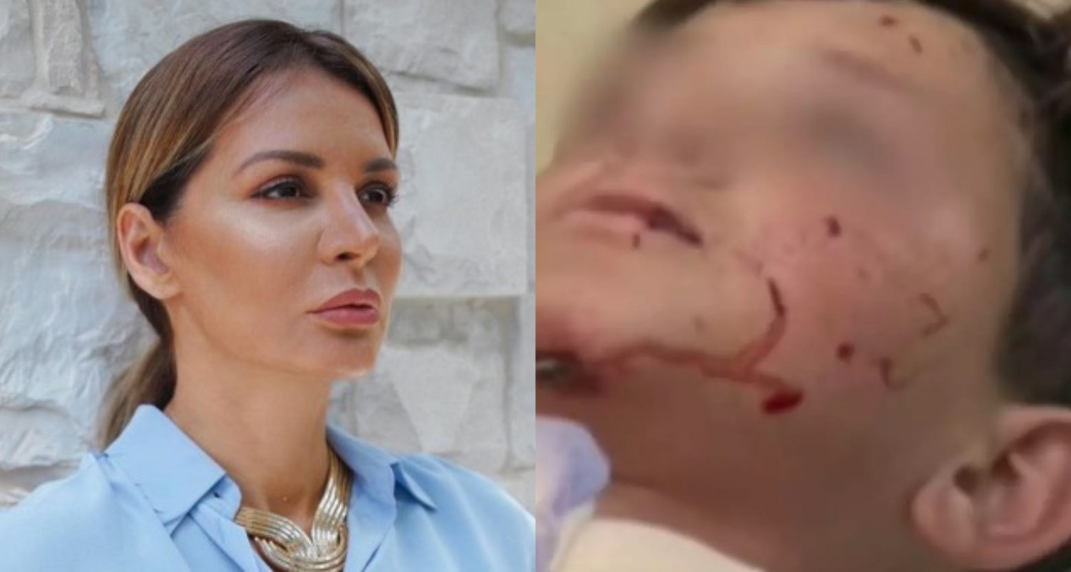 Μαρία Καλάβρια: Ο ανιψιός της δέχθηκε επίθεση από σκύλο - «Έχει σοβαρά τραύματα στον λαιμό και το πρόσωπο»
