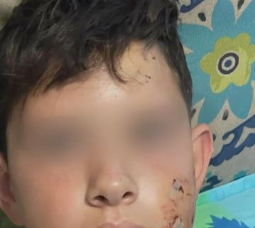 Λαγονήσι: Σκύλος κατασπάραξε αγοράκι την ώρα που πήγαινε στο σχολείο