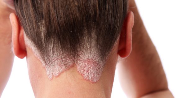 Πιο ευάλωτοι στην κατάθλιψη οι ασθενείς με ψωρίαση