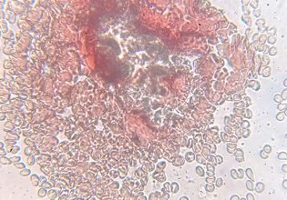 Genesis Pharma – Incyte: Επέκταση εμπορικής συμφωνίας για 11 χώρες