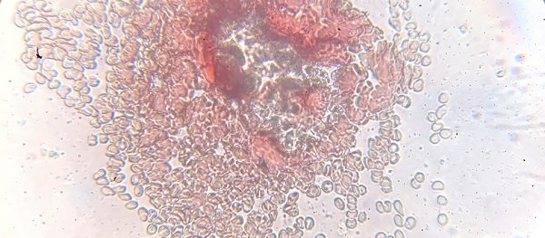 Genesis Pharma – Incyte: Επέκταση εμπορικής συμφωνίας για 11 χώρες