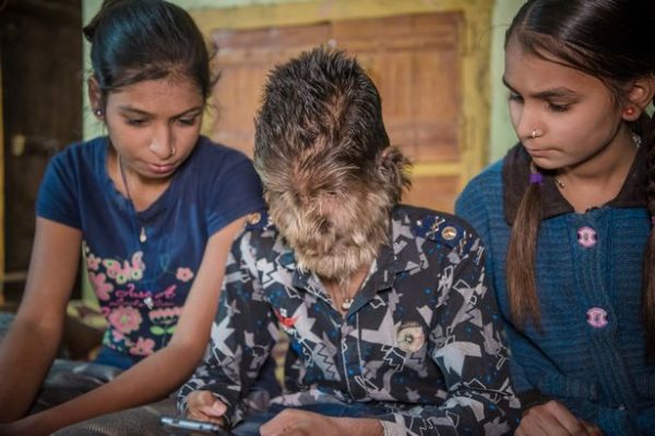 Ινδία: Ο 17χρονος με το σύνδρομο του «Λυκανθρώπου» – «Νιώθω ότι είμαι μοναδικός»