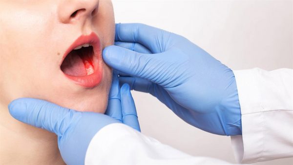 Καρκίνος τους στόματος: Οι αιτίες που οδηγούν στην ασθένεια