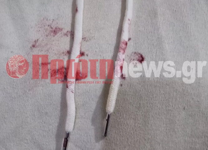 Ηλεία: Στο χειρουργείο 13χρονη μετά από χτύπημα που δέχτηκε από τον ίδιο της τον πατέρα