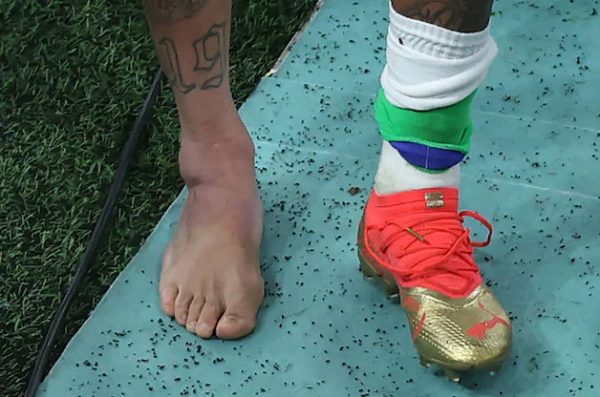 Μουντιάλ 2022: Ο πρησμένος αστράγαλος του Νεϊμάρ από τον τραυματισμό που υπέστη