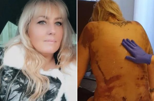 Πήγε στην Τουρκία για λιποαναρρόφηση και το δέρμα της κόντεψε να σαπίσει
