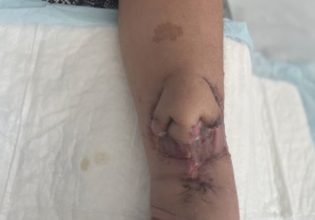 «Φύτρωσε»… μύτη στο χέρι της για να την κάνει μεταμόσχευση στο πρόσωπο