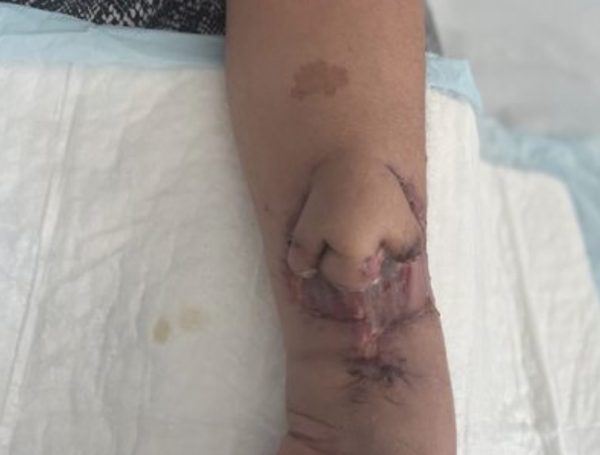 «Φύτρωσε»… μύτη στο χέρι της για να την κάνει μεταμόσχευση στο πρόσωπο