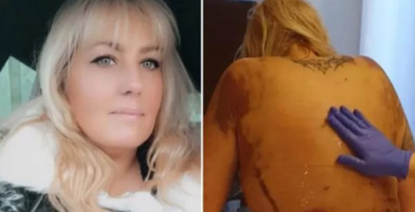 Τουρκία: Πήγε για λιποαναρρόφηση στην Κωνσταντινούπολη και κόντεψε να πεθάνει