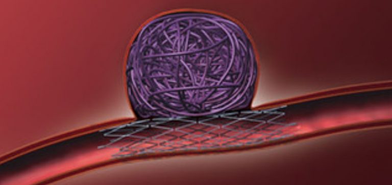 Έξι βήματα για καλύτερη αντιμετώπιση στα ανευρύσματα αορτής