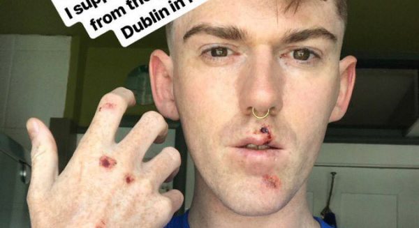 Δουβλίνο: Άγρια επίθεση από ομάδα ανδρών σε τρεις drag queens