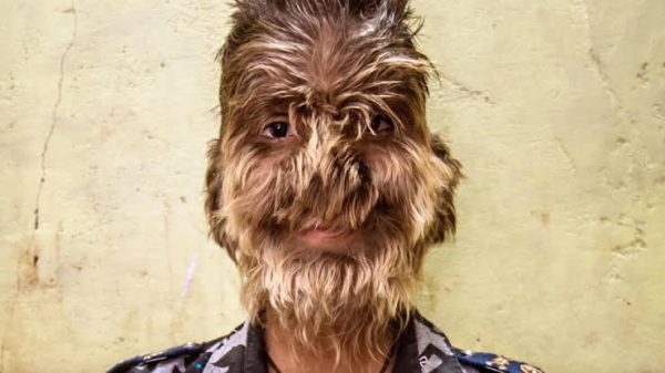 Ινδία: Ο 17χρονος με το σύνδρομο του «Λυκανθρώπου» – «Νιώθω ότι είμαι μοναδικός»