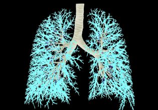 Στο 50% η θνησιμότητα από καρκίνο πνεύμονα σε προχωρημένα στάδια
