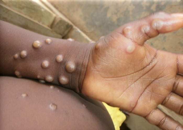 Ευλογιά των πιθήκων: Η ασθένεια μετονομάζεται σε «mpox» για να καταπολεμηθεί το στίγμα