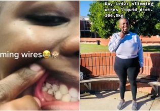 TikTok: Γυναίκα έδεσε τα δόντια της με σύρμα για να μην τρώει