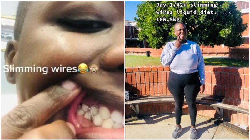 TikTok: Γυναίκα έδεσε τα δόντια της με σύρμα για να μην τρώει