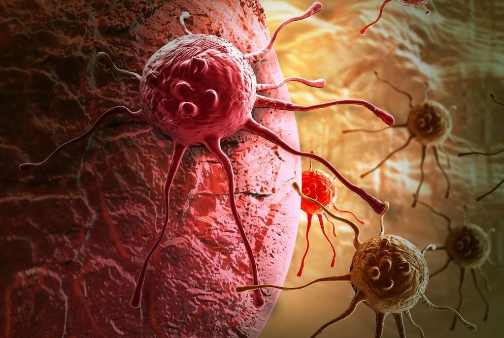 Απαραίτητος ο πολυγονιδιακός έλεγχος για τον καρκίνο του μαστού