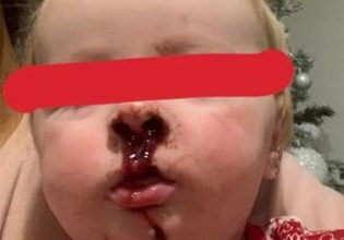 Βρετανία: Διέγνωσαν βρέφος 11 μηνών με επιπεφυκίτιδα αλλά είχε στρεπτόκοκκο