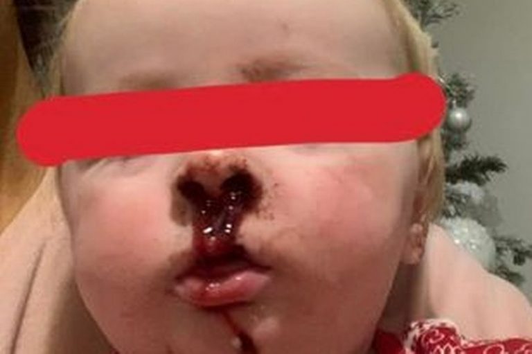 Βρετανία: Διέγνωσαν βρέφος 11 μηνών με επιπεφυκίτιδα αλλά είχε στρεπτόκοκκο