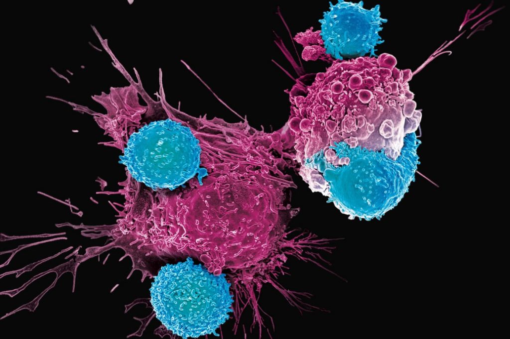 Καρκίνος: Τζελ με κυτταρική θεραπεία σκοτώνει τα υπολείμματα όγκων