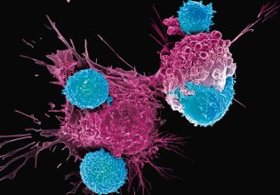 Καρκίνος: Τζελ με κυτταρική θεραπεία σκοτώνει τα υπολείμματα όγκων