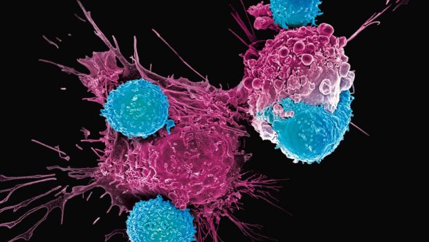 Καρκίνος: Τζελ με κυτταρική θεραπεία σκοτώνει τα υπολείμματα όγκων