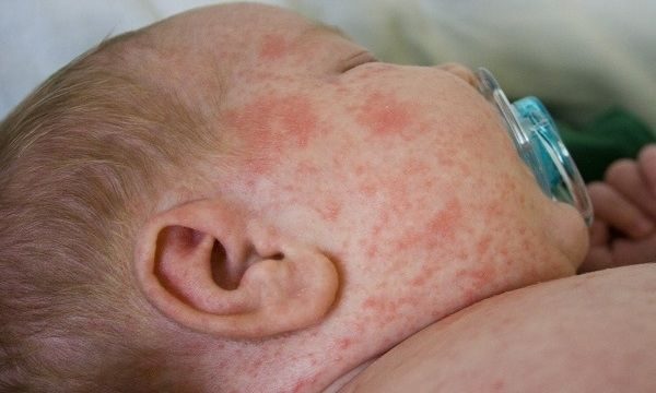 Οστρακιά: Συναγερμός στην Ευρώπη από την αύξηση κρουσμάτων