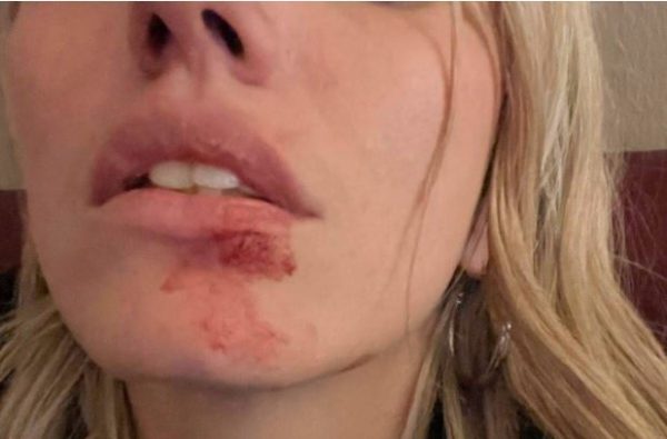 «Έλεγα με αγαπάει και τον συγχωρούσα» – Τι λέει το μοντέλο που δέχθηκε επίθεση από τον πρώην σύντροφό της