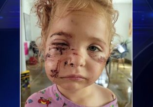 ΗΠΑ: 50 ράμματα σε 5χρονη μετά από άγρια επίθεση σκύλου στη Φλόριντα