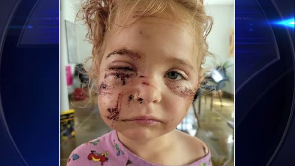 ΗΠΑ: 50 ράμματα σε 5χρονη μετά από άγρια επίθεση σκύλου στη Φλόριντα