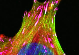 Καρκίνος μαστού: Προκαλεί τις μεγαλύτερες καταστροφικές δαπάνες