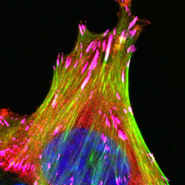 Καρκίνος μαστού: Προκαλεί τις μεγαλύτερες καταστροφικές δαπάνες