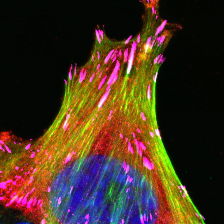 Καρκίνος μαστού: Προκαλεί τις μεγαλύτερες καταστροφικές δαπάνες