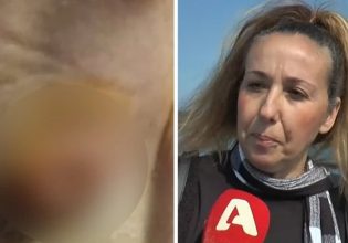Απίστευτη καταγγελία γυναίκας για κέντρο αισθητικής: «Πήγα να κάνω αποτρίχωση και έπαθα φλεηγμονή»