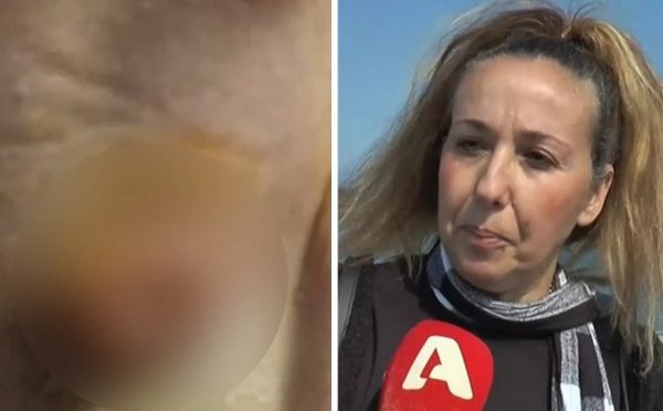 Απίστευτη καταγγελία γυναίκας για κέντρο αισθητικής: «Πήγα να κάνω αποτρίχωση και έπαθα φλεηγμονή»