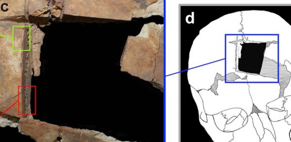 Ισραήλ: Βρέθηκε κρανίο με τετράγωνη τρύπα – Ενδειξη για χειρουργική εγκεφάλου πριν 3.500 χρόνια