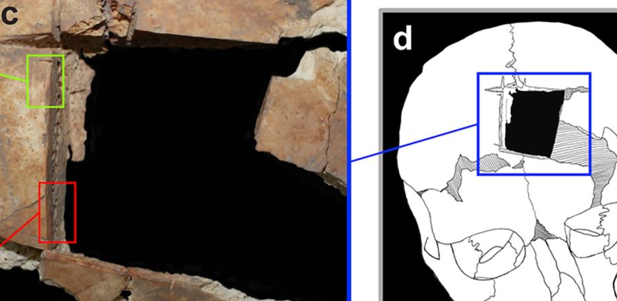 Ισραήλ: Βρέθηκε κρανίο με τετράγωνη τρύπα - Ενδειξη για χειρουργική εγκεφάλου πριν 3.500 χρόνια