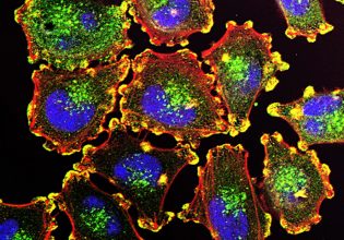 Καρκίνος: Η μεσογειακή διατροφή βοηθά στη θεραπεία του μελανώματος