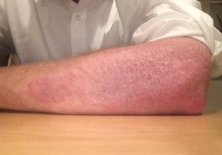 Τα τρόφιμα πυροδοτούν τη φλεγμονή και την ψωρίαση