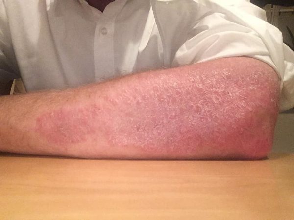 Τα τρόφιμα πυροδοτούν τη φλεγμονή και την ψωρίαση