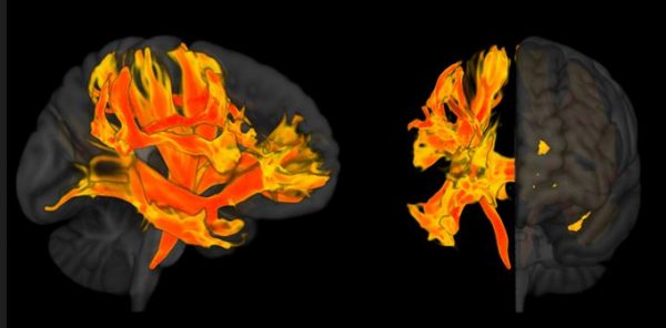 Ερευνητές εντόπισαν περιοχές του εγκεφάλου που επηρεάζονται από την υψηλή πίεση και σχετίζονται με την άνοια