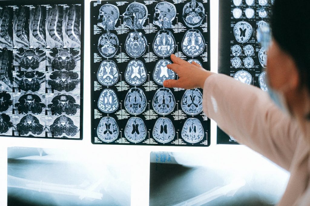Τεχνητή νοημοσύνη με ελληνική συμμετοχή τα βάζει με θανατηφόρο καρκίνο του εγκεφάλου