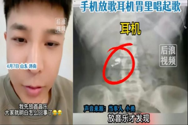 Έγινε viral στην Κίνα: Κατάπιε ασύρματο ακουστικό στον ύπνο του - Το εντόπισε όταν έβαλε μουσική