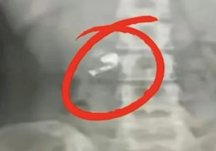 Έγινε viral στην Κίνα: Κατάπιε ασύρματο ακουστικό στον ύπνο του – Το εντόπισε όταν έβαλε μουσική