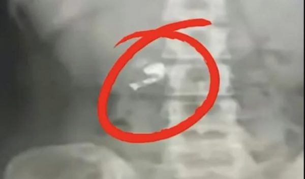 Έγινε viral στην Κίνα: Κατάπιε ασύρματο ακουστικό στον ύπνο του – Το εντόπισε όταν έβαλε μουσική