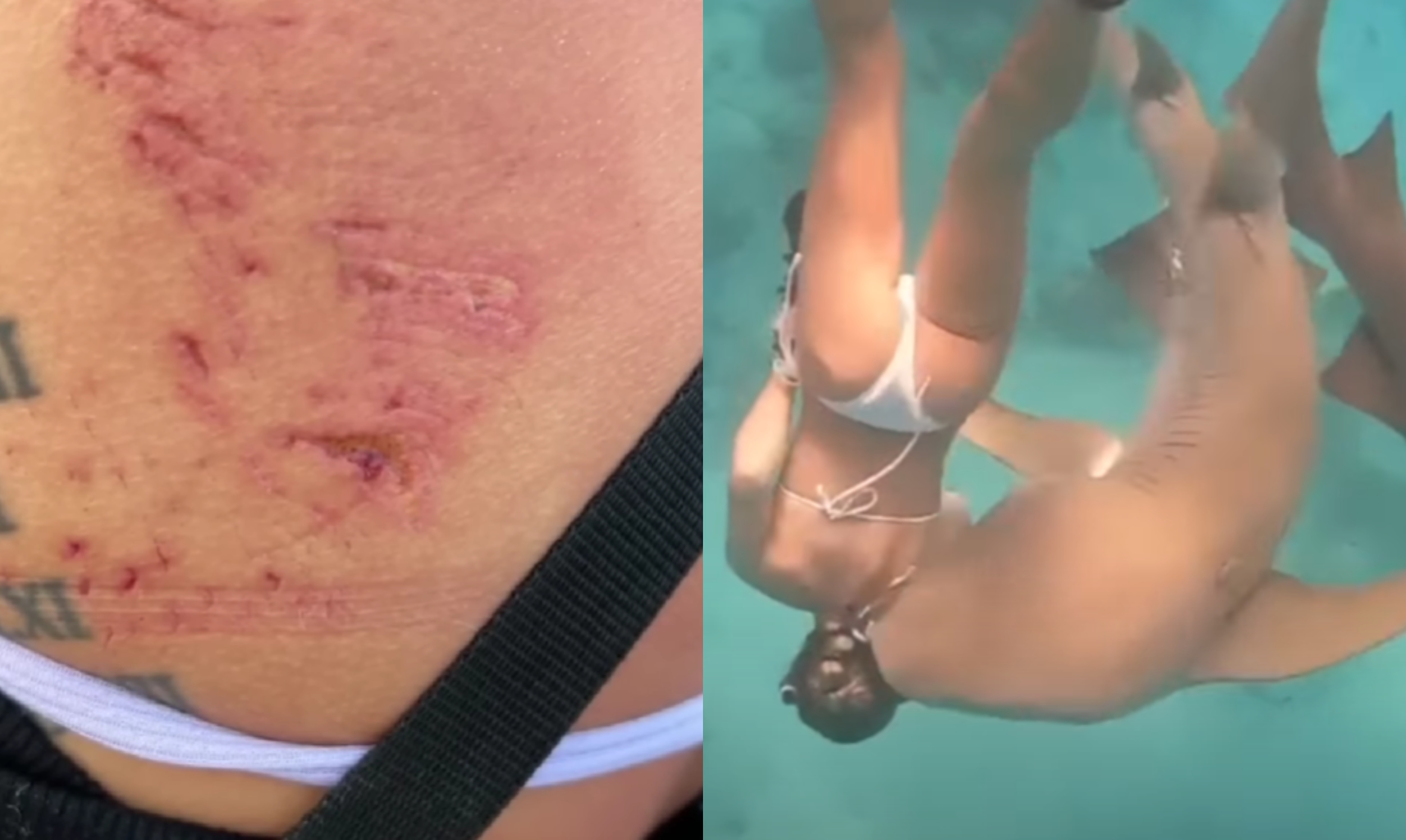 Μαλδίβες: Στιγμές τρόμου για κολυμβήτρια - Τη δάγκωσε καρχαρίας 100 κιλών