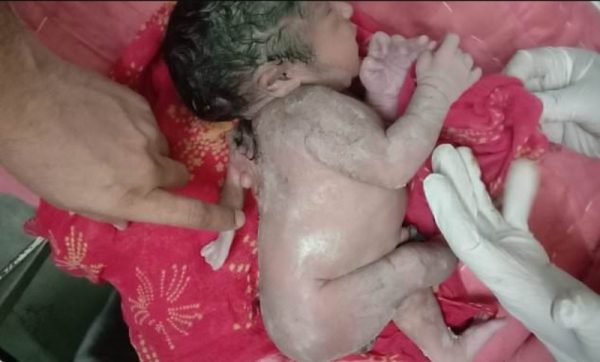 Ινδία: Συγκλονιστικό βίντεο – Γεννήθηκε μωρό με τρία χέρια